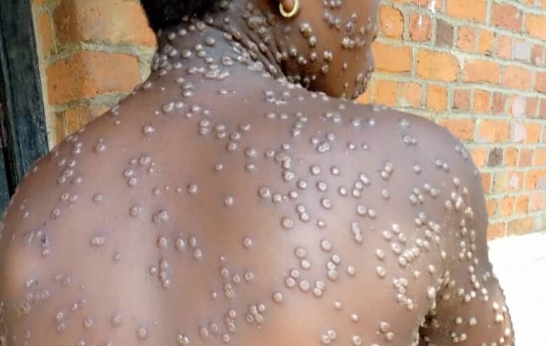 Épidémiologie : Le Mpox s’étend à deux autres villes malgaches et oblige les autorités à prendre des mesures pour stopper l’avancée